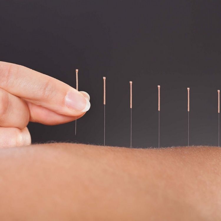 What Does Acupuncture Really Do—And Feel Like?