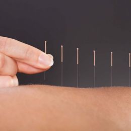 What Does Acupuncture Really Do—And Feel Like?