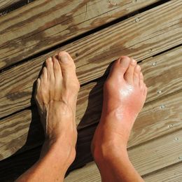 Help for Swollen Ankles and Feet