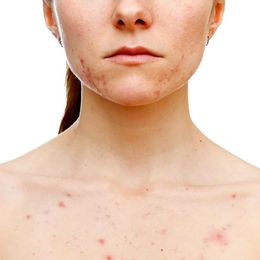 Cures for Adult Acne