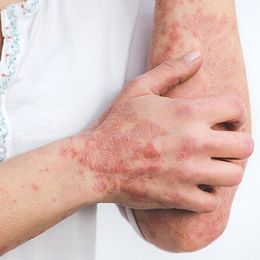 Two Psoriasis Treatments May Hold Key to Real Relief