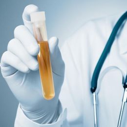 Bladder Cancer Test