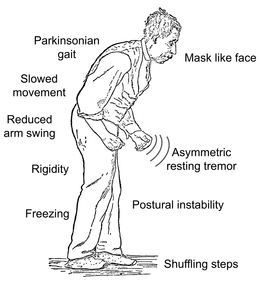 Exercise May Protect Against Parkinson's