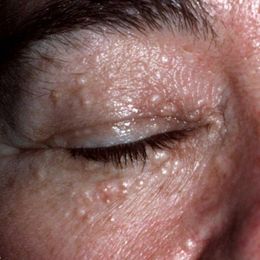So Long, Syringoma: How to Get Rid of Bumps Under the Eyes