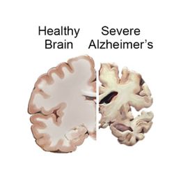 Alzheimer's Drug Helps MS Patients