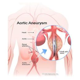 Minimally Invasive Surgery Fixes Aneurysms