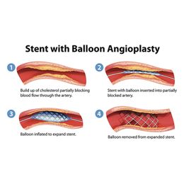 'Cardio-Cocktail' a Good Substitute for Angioplasty