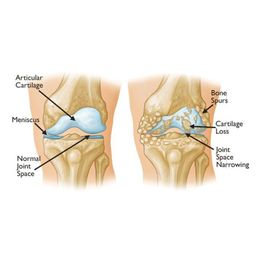 Osteoporosis Drugs Prevent Arthritis, Too