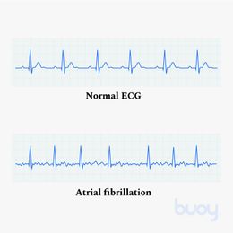 New Pocket Pill 94% Effective for Atrial Fibrillation