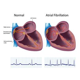 Minimally Invasive Surgery Works for Atrial Fibrillation