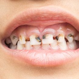 Saliva Test Tells How Many Cavities Children Will Get