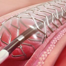 Coated Stents Superior Over the Long Term