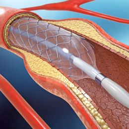 Doctors Study "Real-World" Results Of Drug-Coated Stents