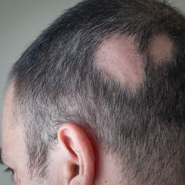 Natural Remedies to Beat Hair Loss