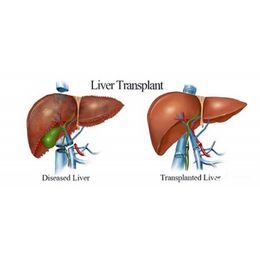 Factors that Influence Liver Transplant Survival