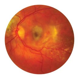 Drug Slows Age-Related Macular Degeneration