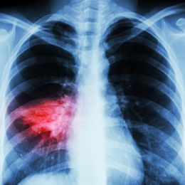 Heartburn Drugs May Cause Pneumonia