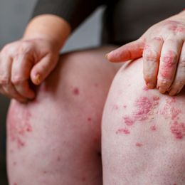 Two New Psoriasis Treatments May Hold Key to Real Relief