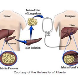 Diabetes Cured! First Living Donor Cell Transplant