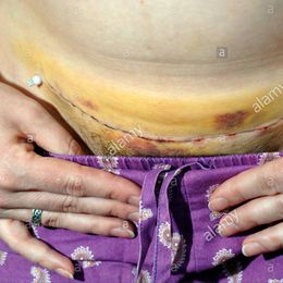 Once a Caesarean Always a Caesarean?