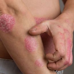 Drug Clears Psoriasis in Up to 80% of Patients