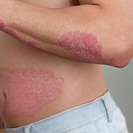 What Is Psoriasis?