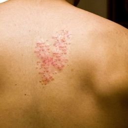 Spot and Treat Shingles Quickly to Avoid Years of Pain