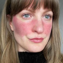 Rosacea: Millions Have This Skin Disease and Don't Know It