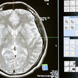 Breakthroughs for Brain Tumor Patients