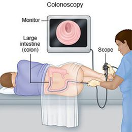 Are Follow-Up Colonoscopies Always Necessary?