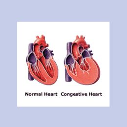 Rheumatoid Arthritis May Cause Congestive Heart Failure