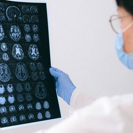 A Quick Test That May Help Predict Major Stroke Risk