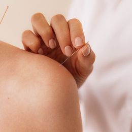 Acupuncture May Aid In Vitro Fertilization