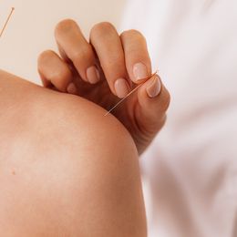 Acupuncture May Help Ease Hay Fever