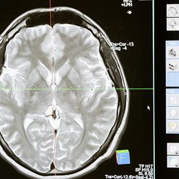 What's Slowly Killing Your Brain