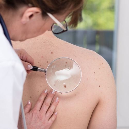 Researchers Detect Factor in Melanoma's Growth