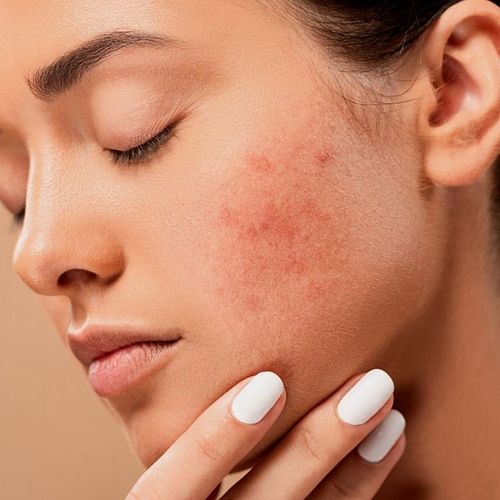 Antibiotics Risk for Acne Sufferers