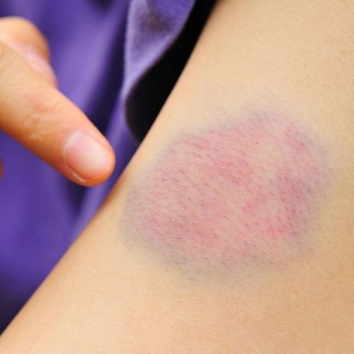 Homeopathic Remedy Reduces Bruising