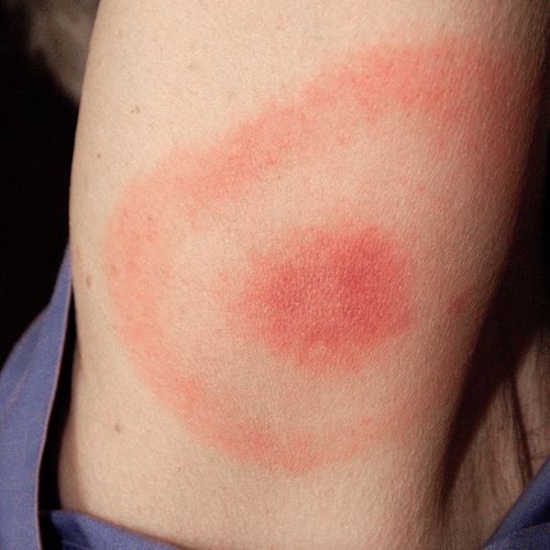 Lyme Disease: Science Finds the Inside Story