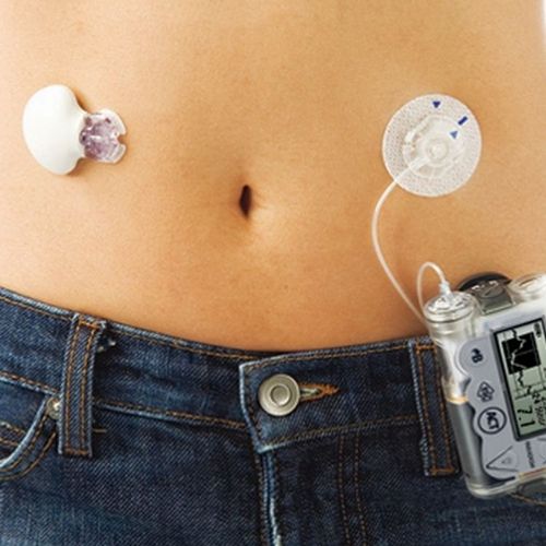 Artificial Pancreas for Type 1 Diabetes