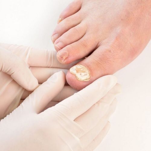 Toenail Fungus Trouble...and a Unique Cure