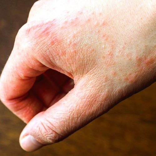 Astounding! 70% Have 14k Mystery Rash