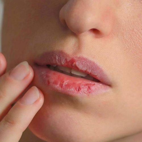 Refreshing Solutions for Dry Mouth