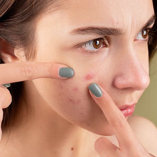 Acne Drug May Not Be Linked to Depression