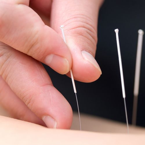 Can Acupuncture Really Help You?