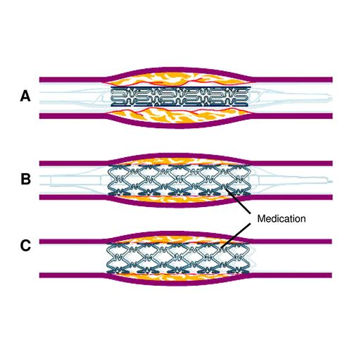 Study: Drug-Coated Stents Better than Angioplasty