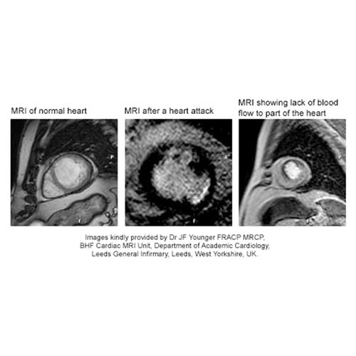 Computer Helps MRI Measure Heart Damage