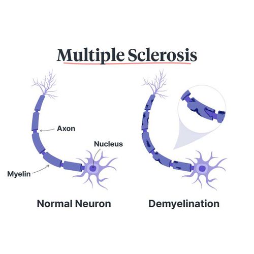 Suspension of MS Drug Does Not Destroy Hopes