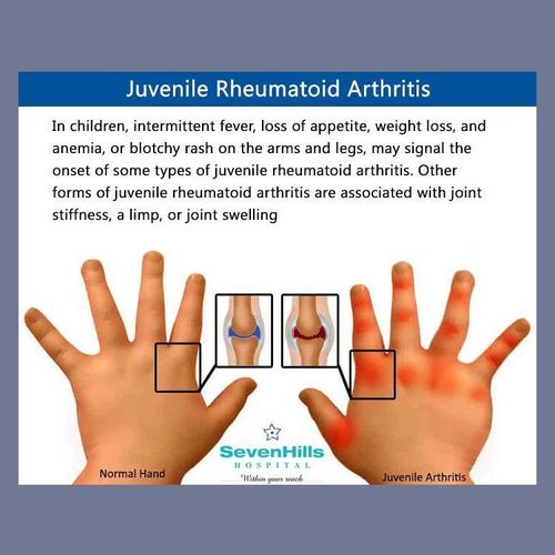 New Oral Treatment Option for Juvenile Rheumatoid Arthritis