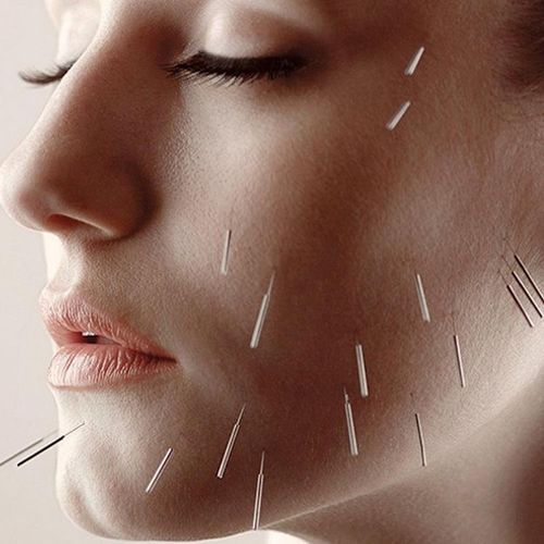Acupuncture Can Be as Effective as Botox